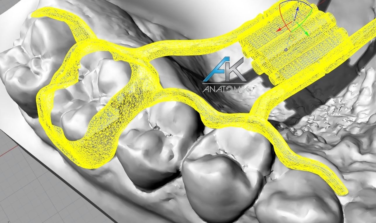 Conception Disjoncteur Orthodontie
